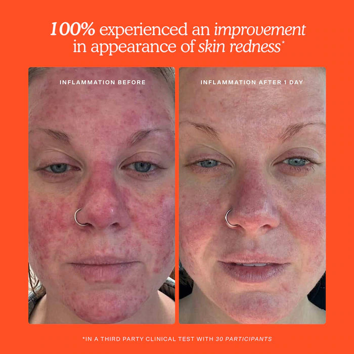 SOS Daily Hypochlorous Acid Spray for Breakouts & Redness - Tower 28