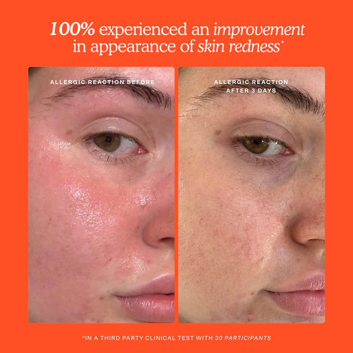 SOS Daily Hypochlorous Acid Spray for Breakouts & Redness - Tower 28