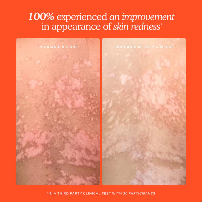 SOS Daily Hypochlorous Acid Spray for Breakouts & Redness - Tower 28